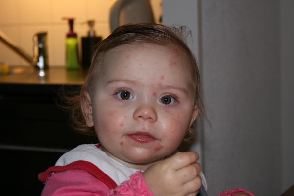 Alana waterpokken, geplaatst door mama Lizanne op 2009-01-11